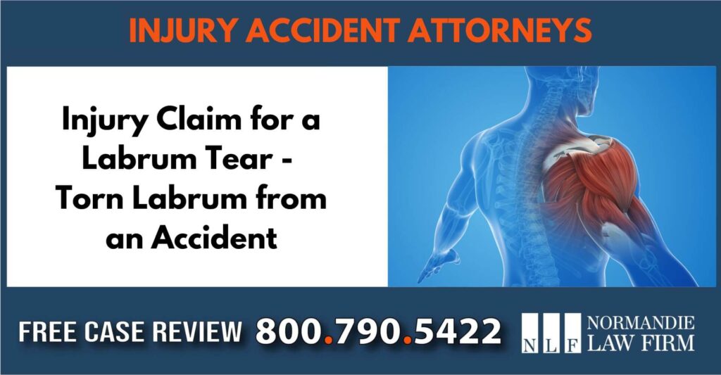 Injury Claim for a Labrum Tear - Torn Labrum from an Accident sue liability lawyer attorney